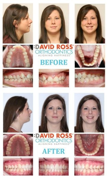 Invisalign Adult Crowding David Ross Orthodontics in Hanvover, PA